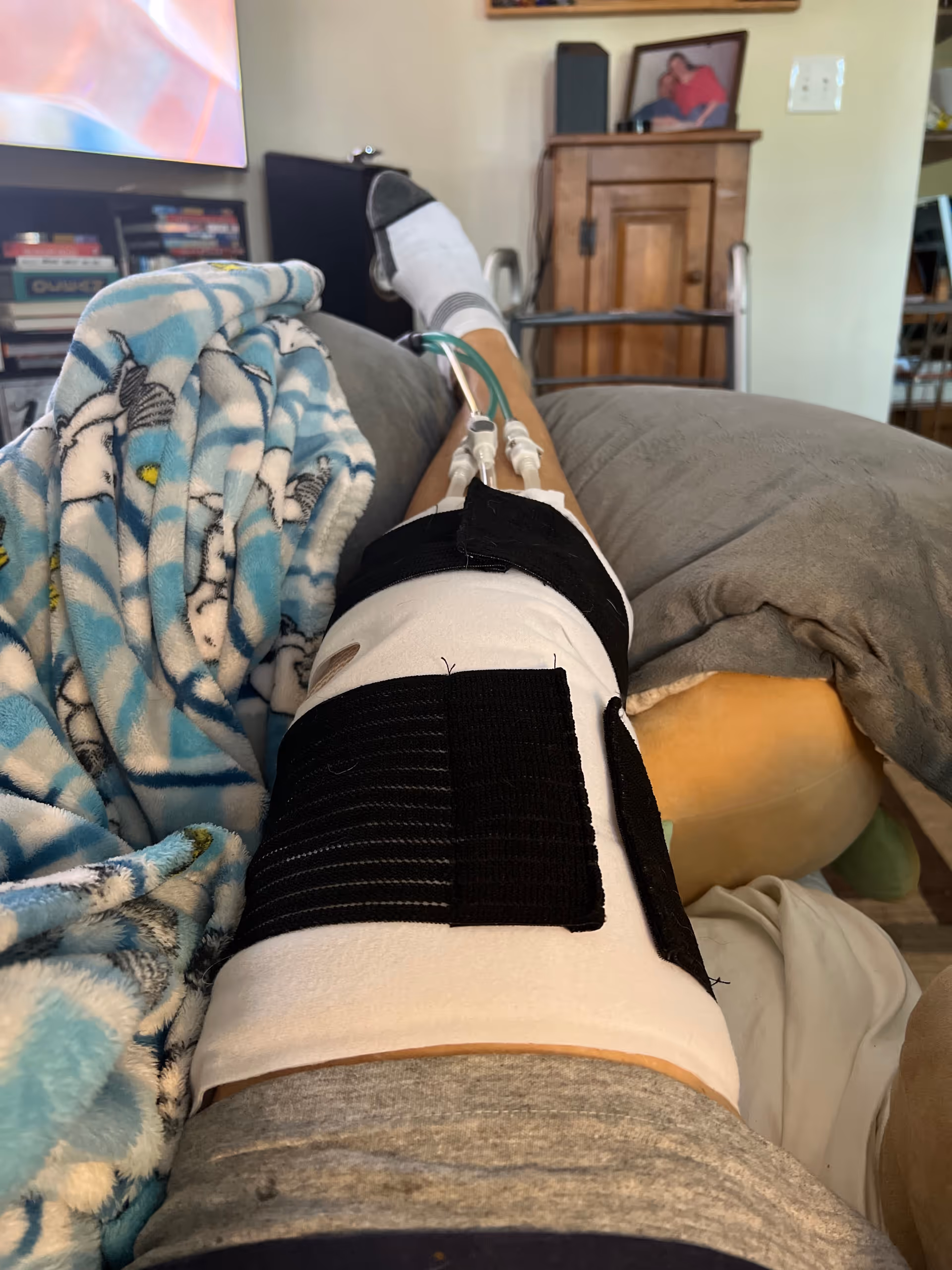 Patient's leg with knee immobilizer rests on a couch in a living room.